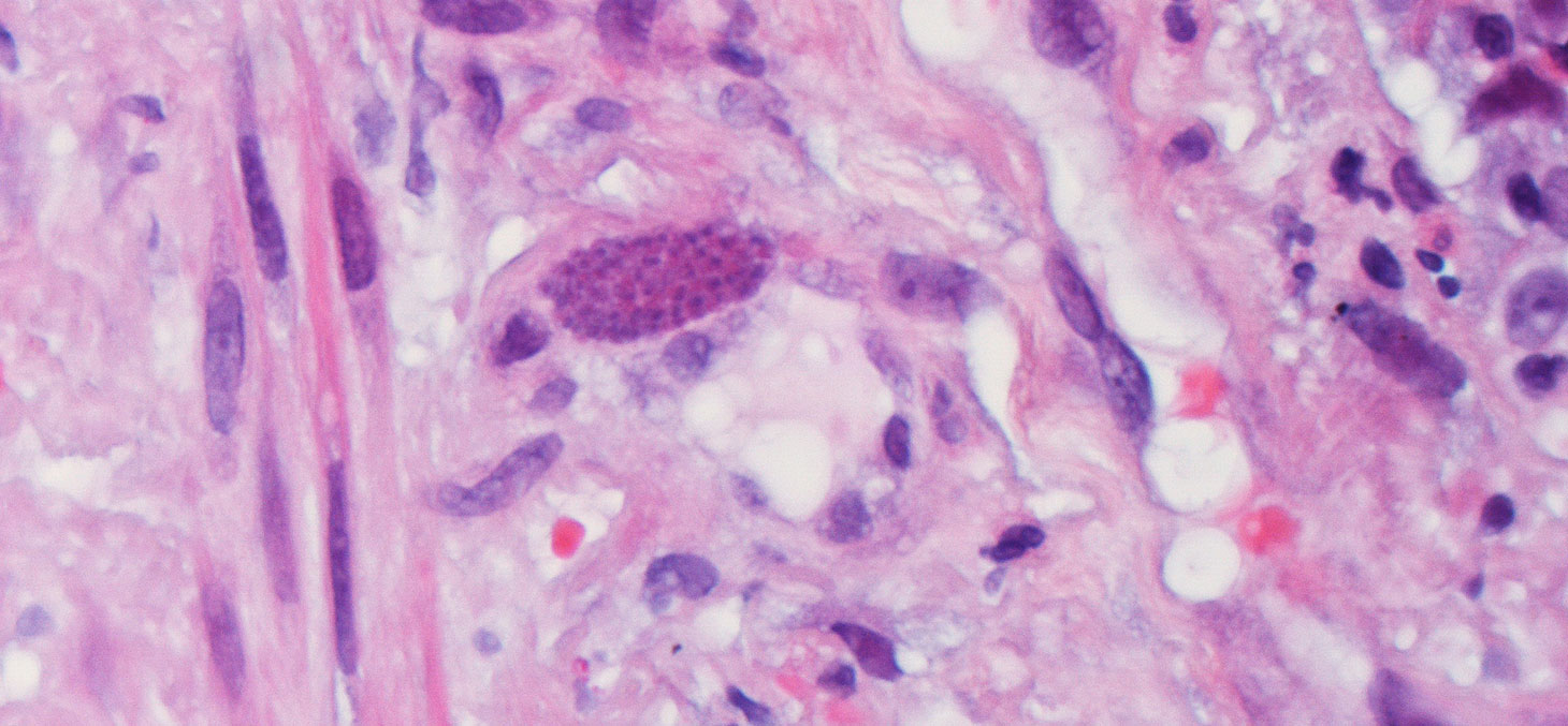 Toxoplasmosis